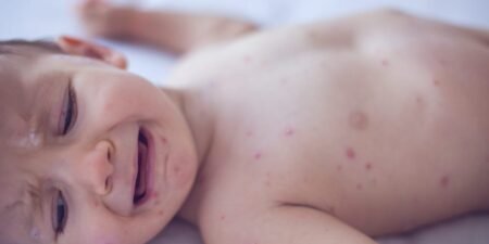 I’m a pediatrician working in the middle of Texas’s measles outbreak. Here’s what I want parents to know.