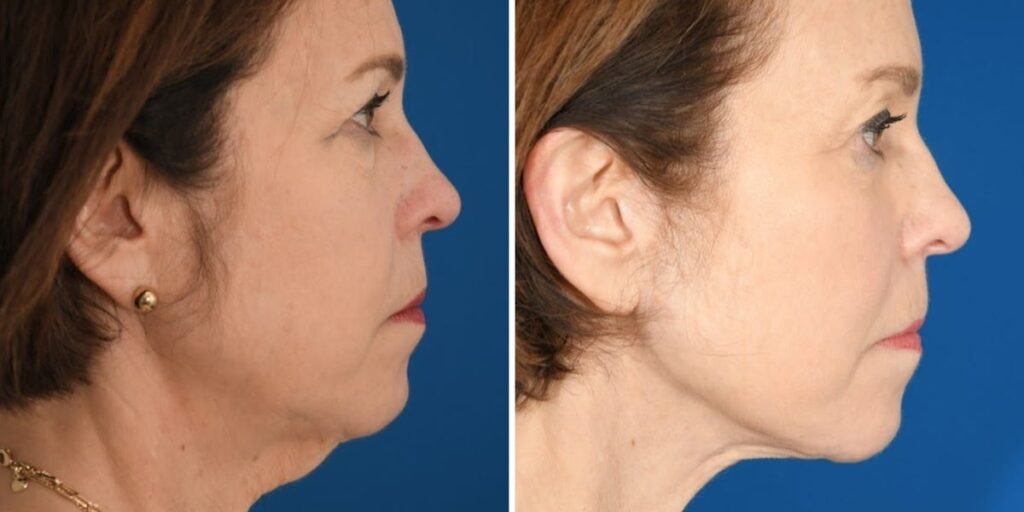 I’ve spent ,000 on cosmetic procedures at 65. It’s been life-changing for my career and confidence.