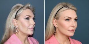 AI face is taking over — and driving plastic surgeons crazy AI face is taking over — and driving plastic surgeons crazy
