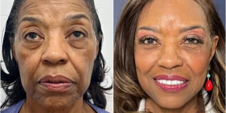 I paid 2,000 for a facelift at 71. I wish I could have done it a decade ago, but I couldn’t afford it.