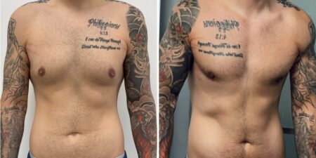 Men get cosmetic surgery, too. I spent ,000 on plastic surgery, and I don’t regret it.